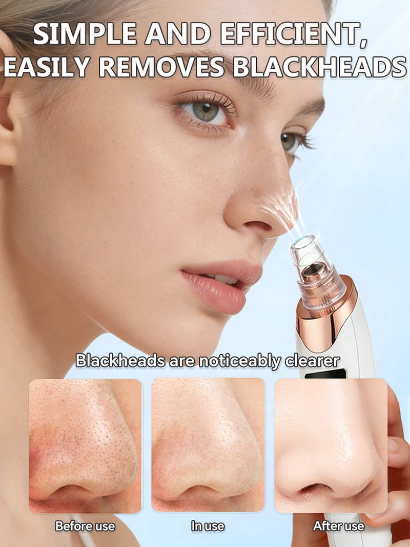 Blackhead Remover Pimples and Blackheads Vacuum Pores Removal Facial Skin Cleansing Device for Deep Cleaning Home