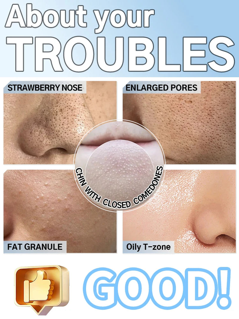 Blackhead Remover Pimples and Blackheads Vacuum Pores Removal Facial Skin Cleansing Device for Deep Cleaning Home