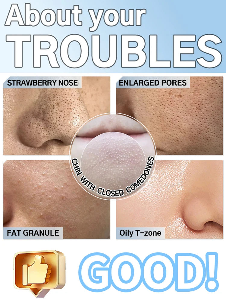 Blackhead Remover Pimples and Blackheads Vacuum Pores Removal Facial Skin Cleansing Device for Deep Cleaning Home